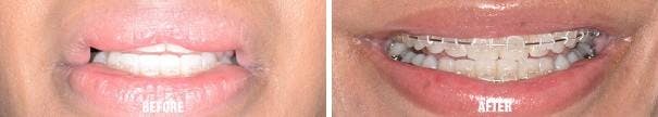 Lip Reduction before and after, frontal.