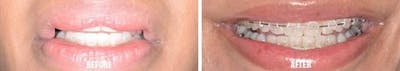 Lip Reduction before and after, frontal.