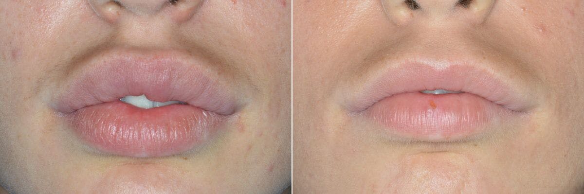 Lip Reduction before and after, frontal.