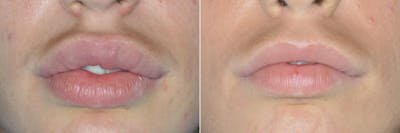 Lip Reduction before and after, frontal.