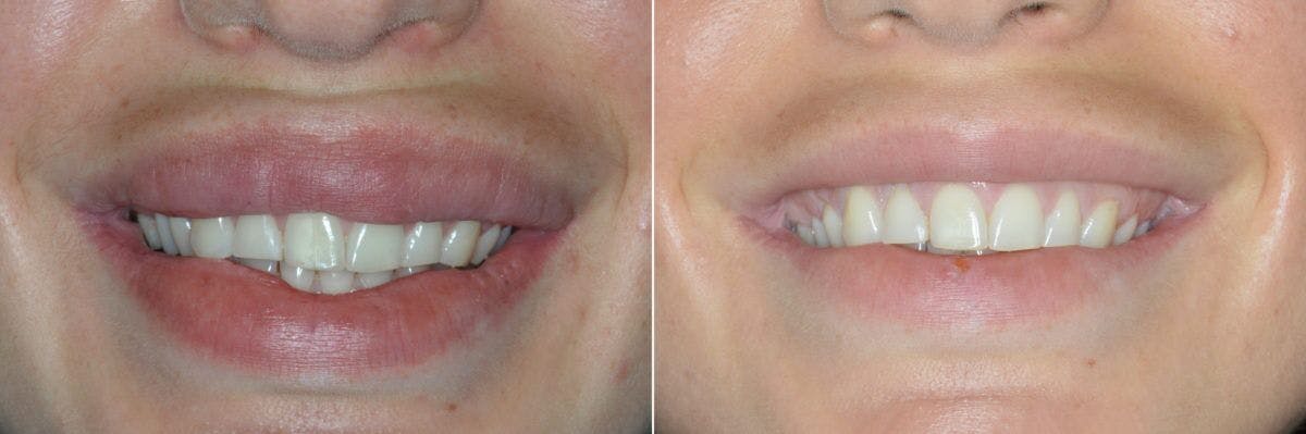 Lip Reduction before and after, frontal.