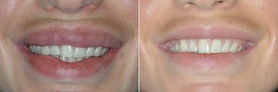 Lip Reduction before and after, frontal.