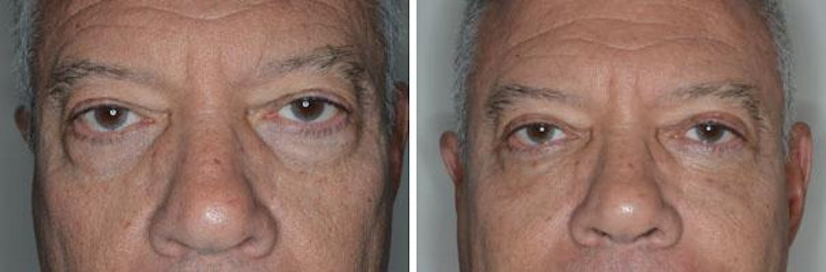 Blepharoplasty before and after, frontal.