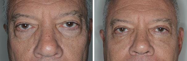 Blepharoplasty before and after, frontal.