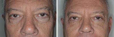 Blepharoplasty before and after, frontal.