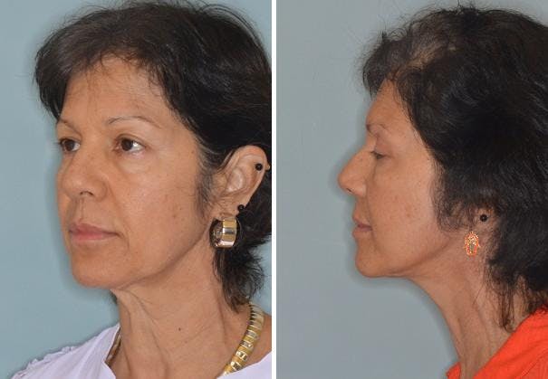 Blepharoplasty before and after, lateral left.