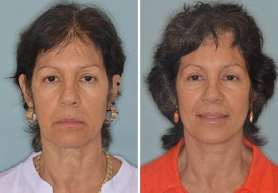 Blepharoplasty before and after, frontal.