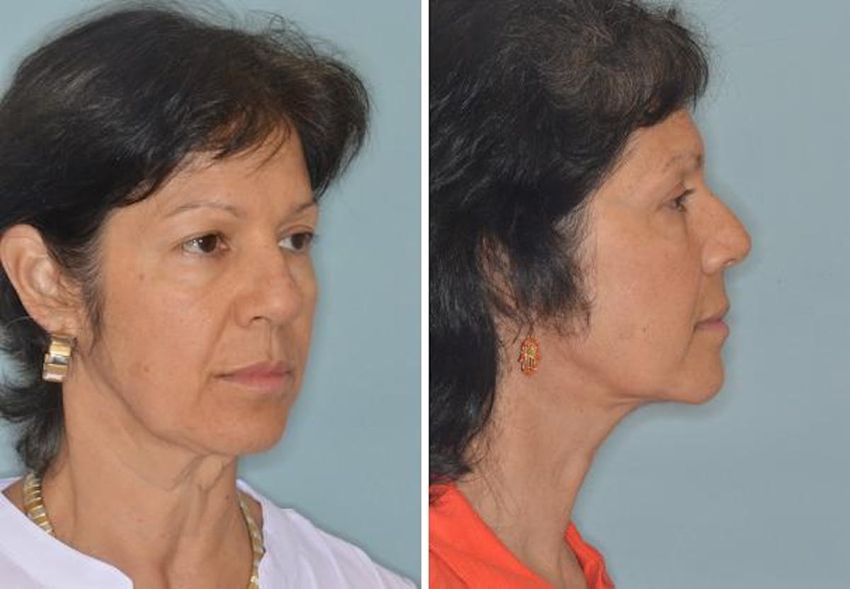 Blepharoplasty before and after, lateral right.