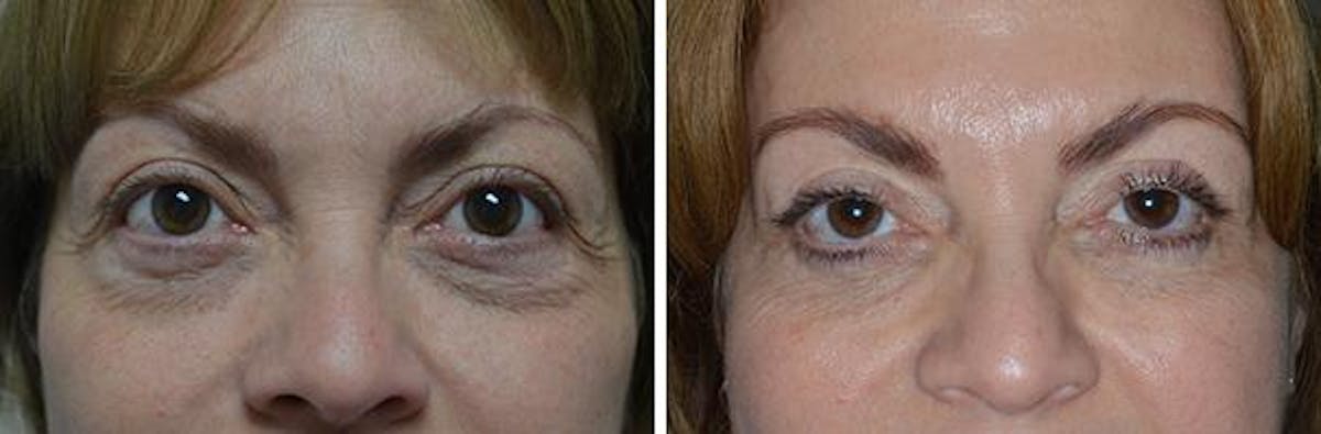 Blepharoplasty before and after, frontal.