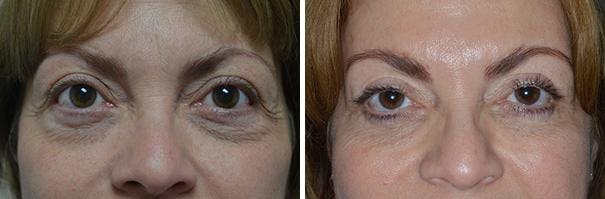 Blepharoplasty before and after, frontal.