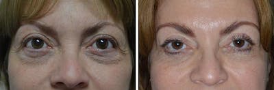 Blepharoplasty before and after, frontal.