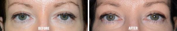Blepharoplasty before and after, frontal.