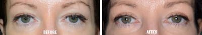 Blepharoplasty before and after, frontal.
