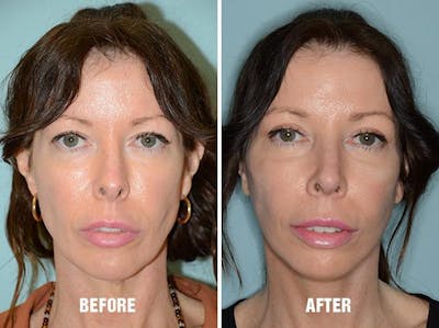 Blepharoplasty before and after, frontal.