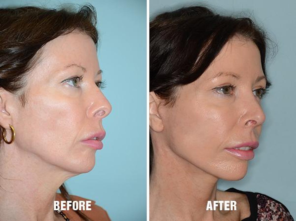 Blepharoplasty before and after, oblique right.