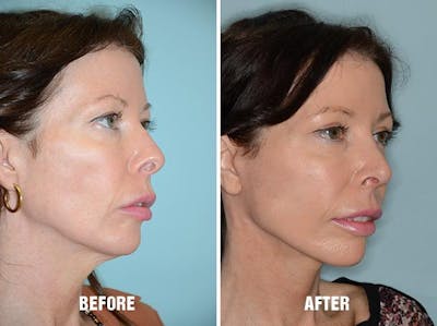 Blepharoplasty before and after, oblique right.