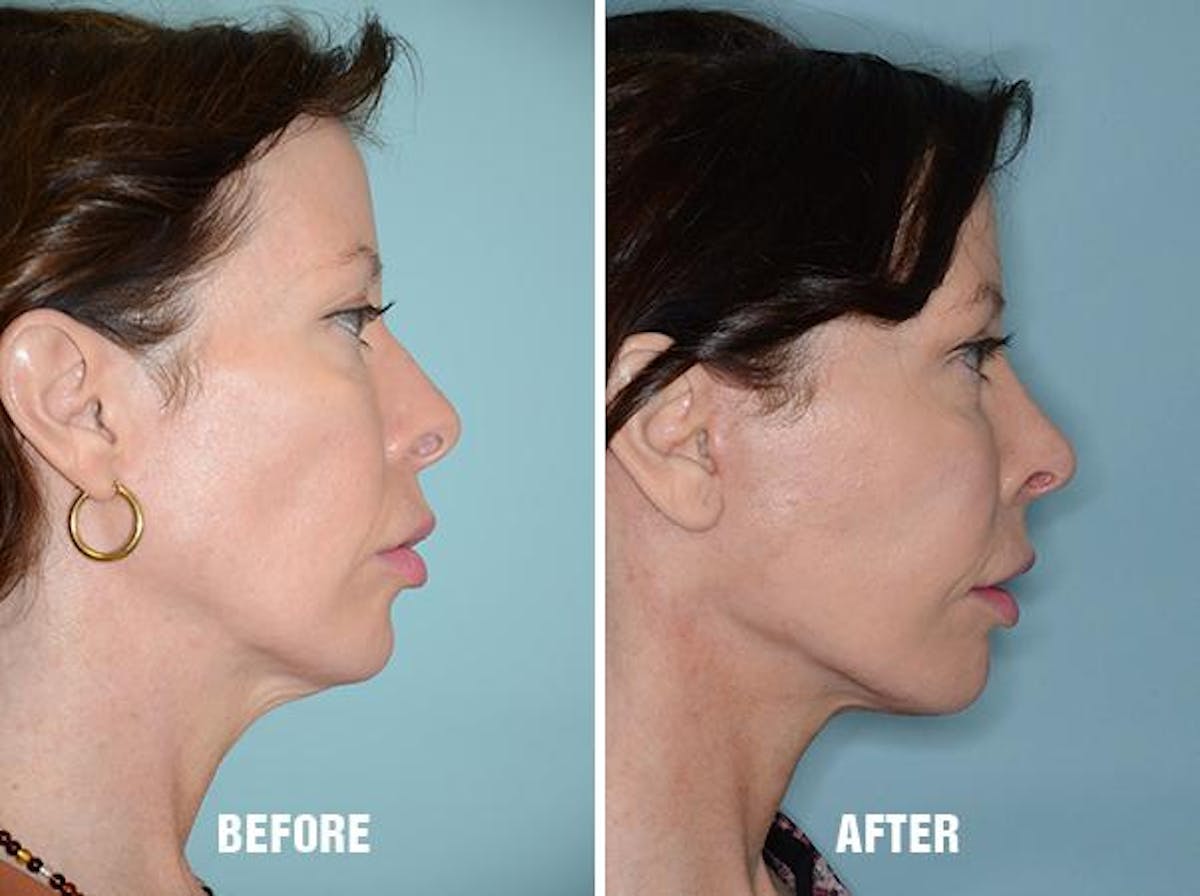 Blepharoplasty before and after, lateral right.