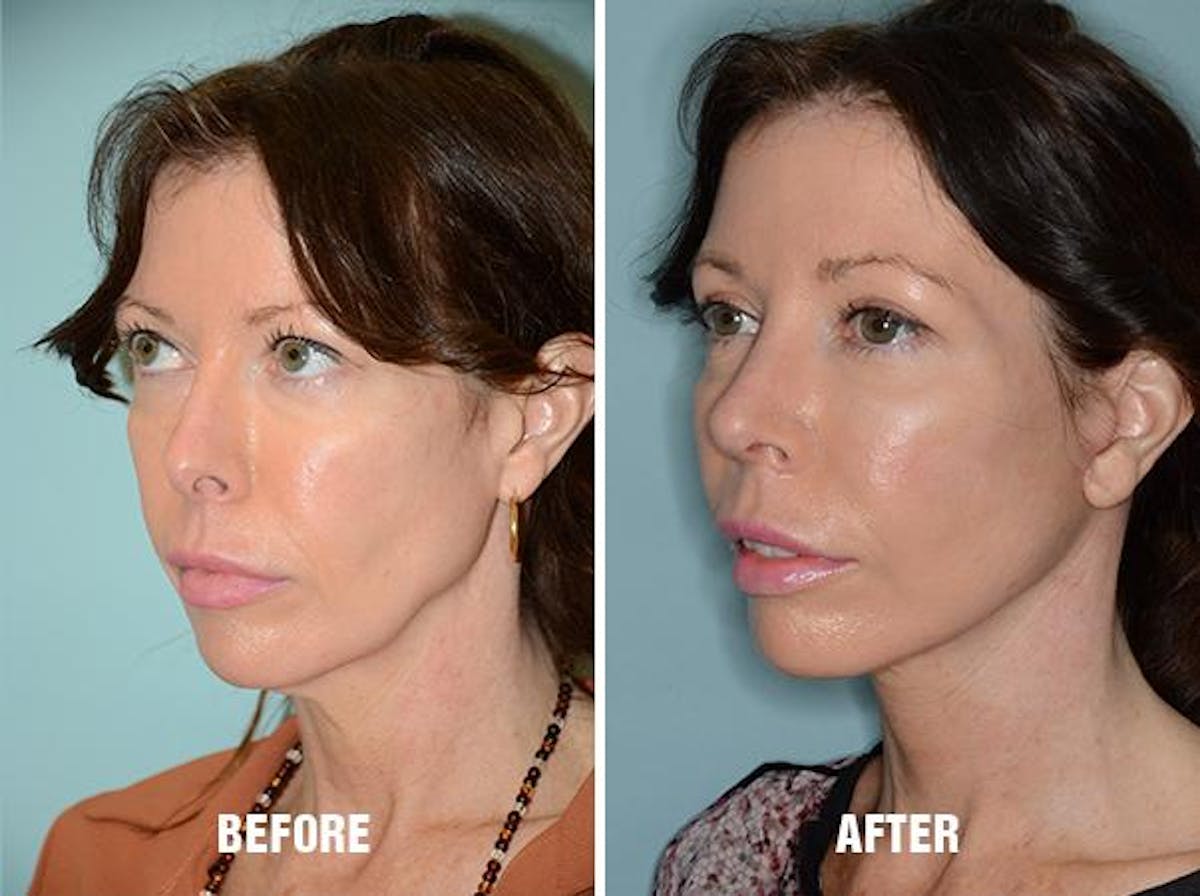 Blepharoplasty before and after, oblique left.