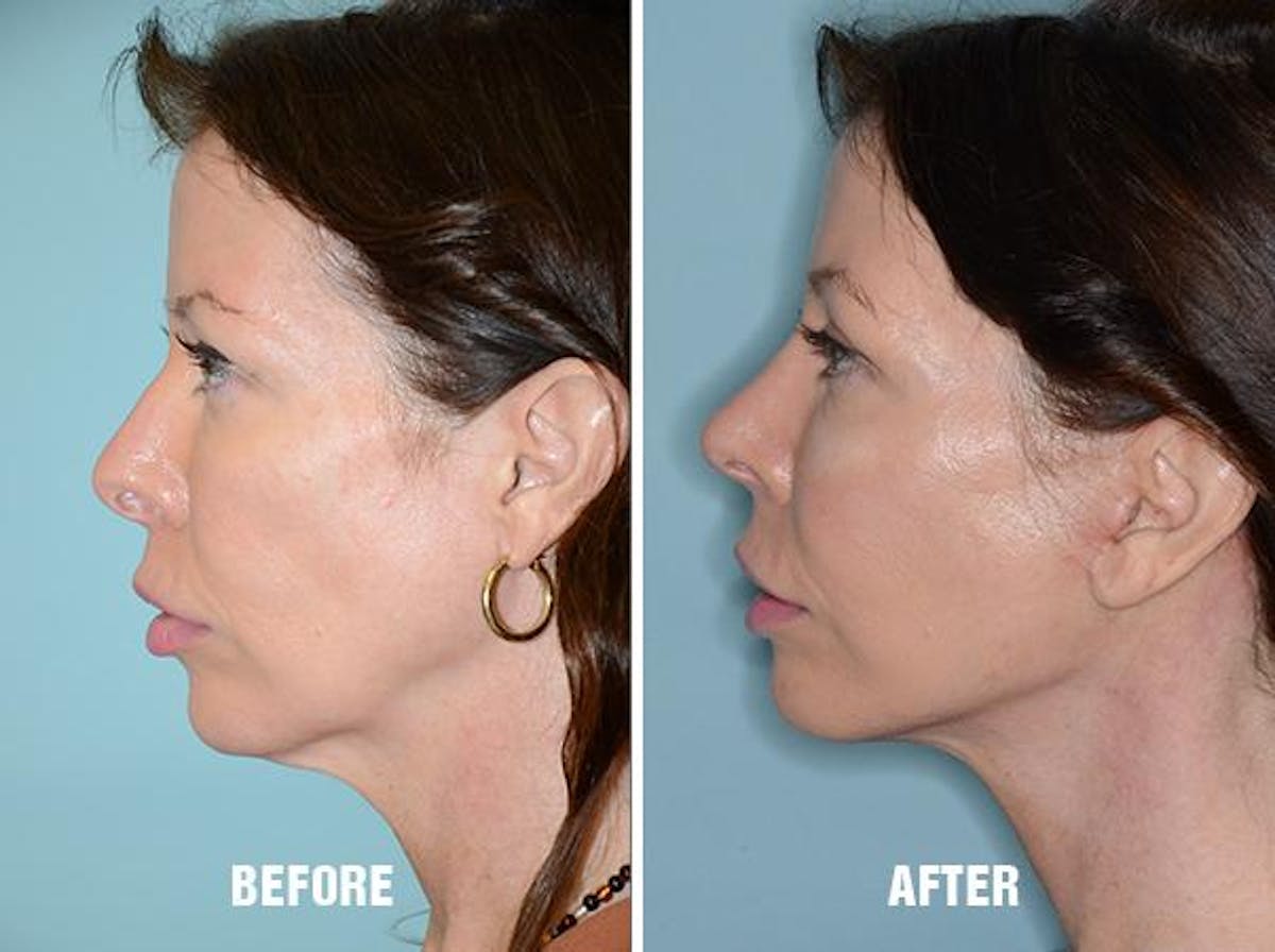 Blepharoplasty before and after, lateral left.