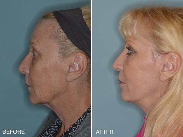 Blepharoplasty before and after, lateral left.
