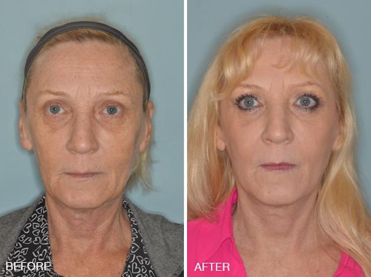 Blepharoplasty before and after, frontal.