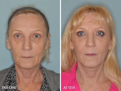 Blepharoplasty before and after, frontal.