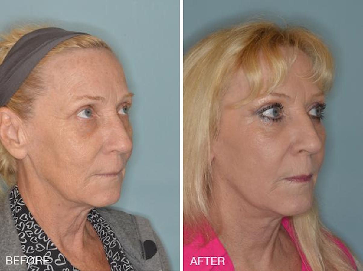 Blepharoplasty before and after, oblique right.