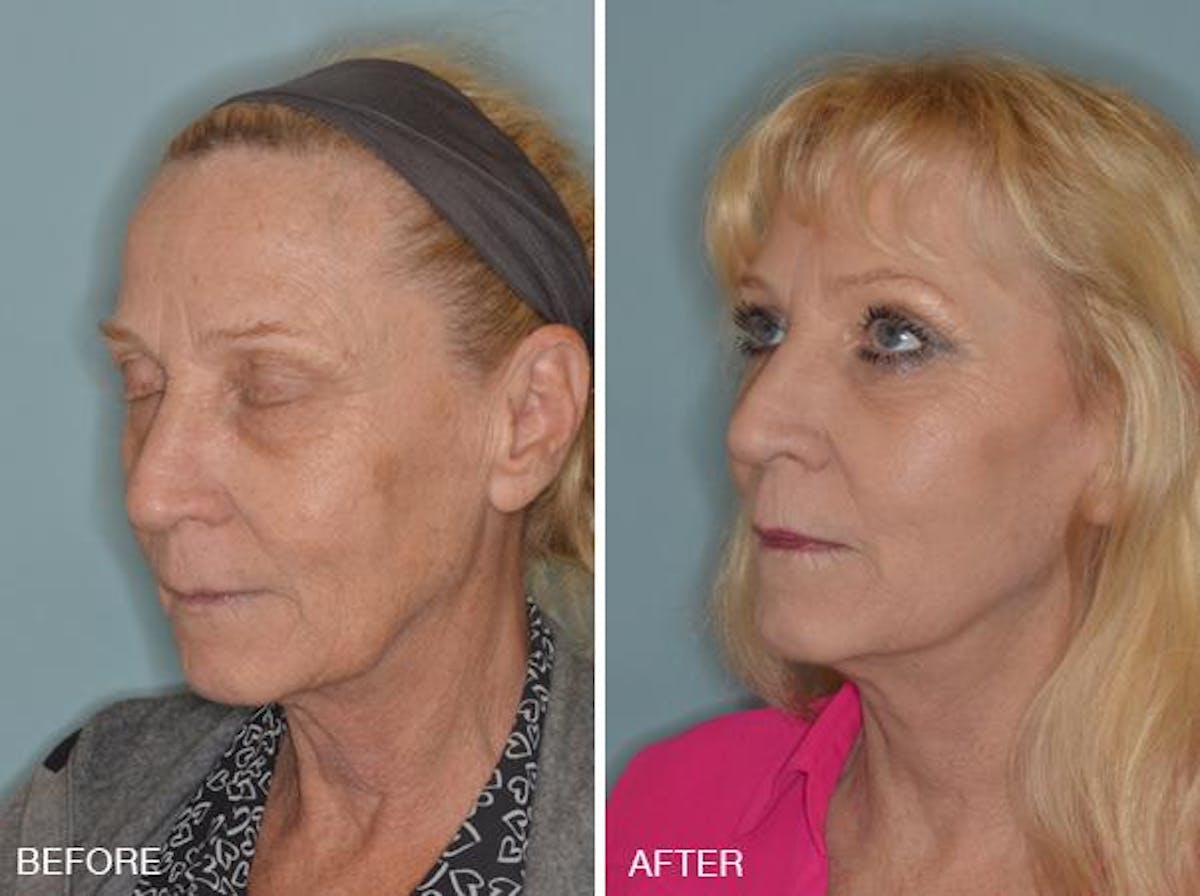 Blepharoplasty before and after, oblique left.