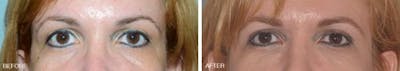 Blepharoplasty before and after, frontal.