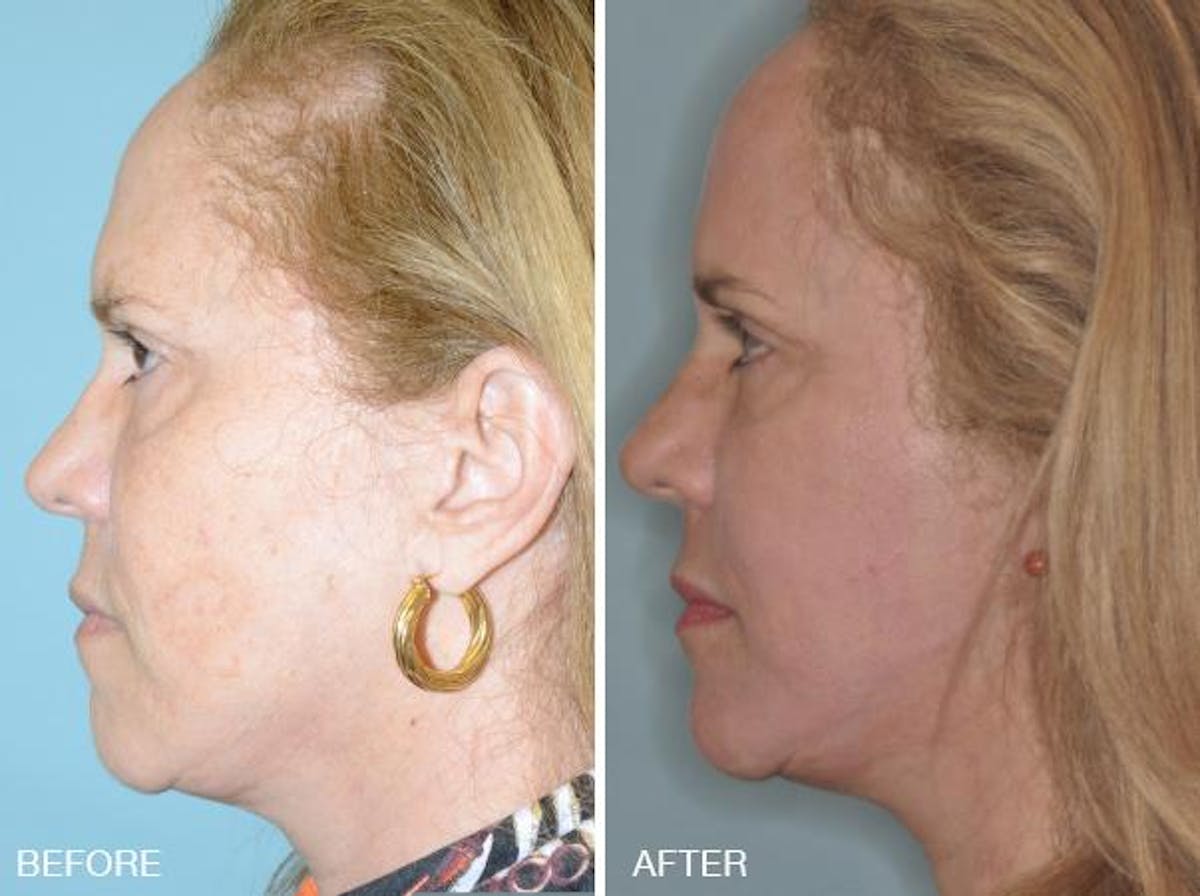 Blepharoplasty before and after, lateral left.