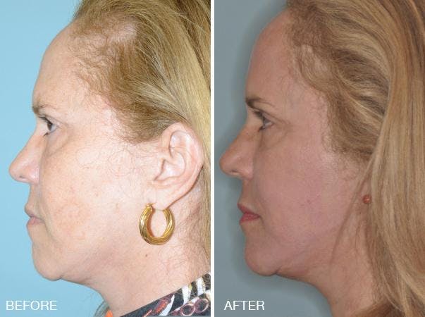 Blepharoplasty before and after, lateral left.