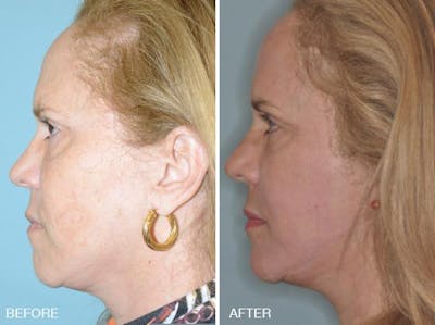 Blepharoplasty before and after, lateral left.