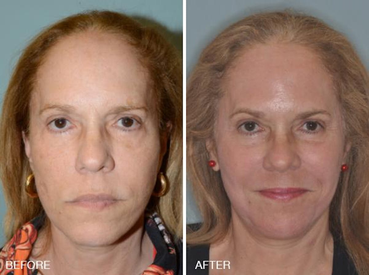 Blepharoplasty before and after, frontal.