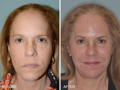 Blepharoplasty before and after, frontal.