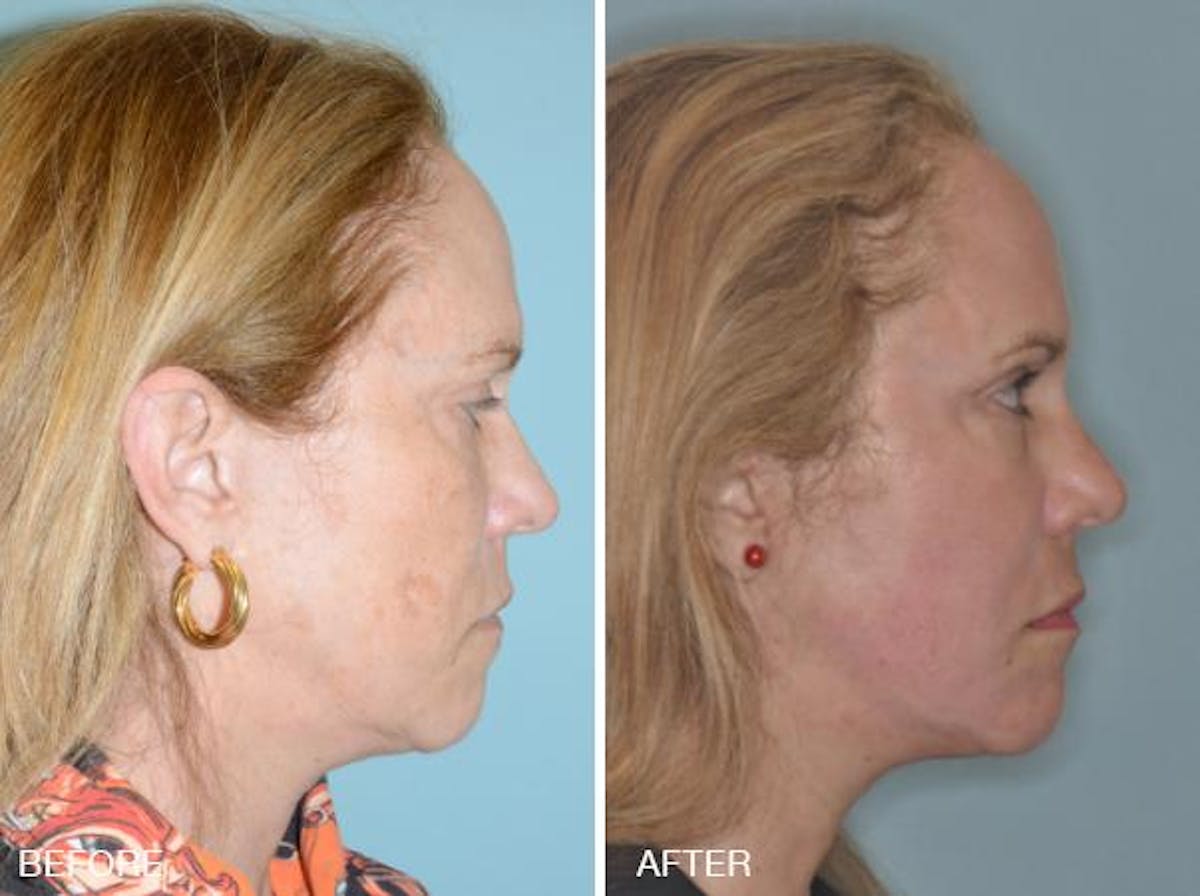 Blepharoplasty before and after, lateral right.