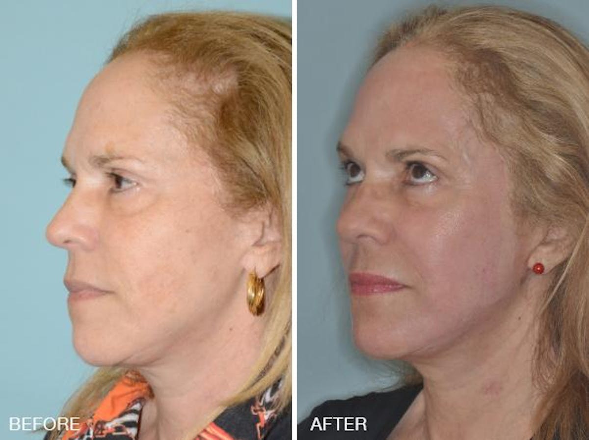 Blepharoplasty before and after, oblique left.