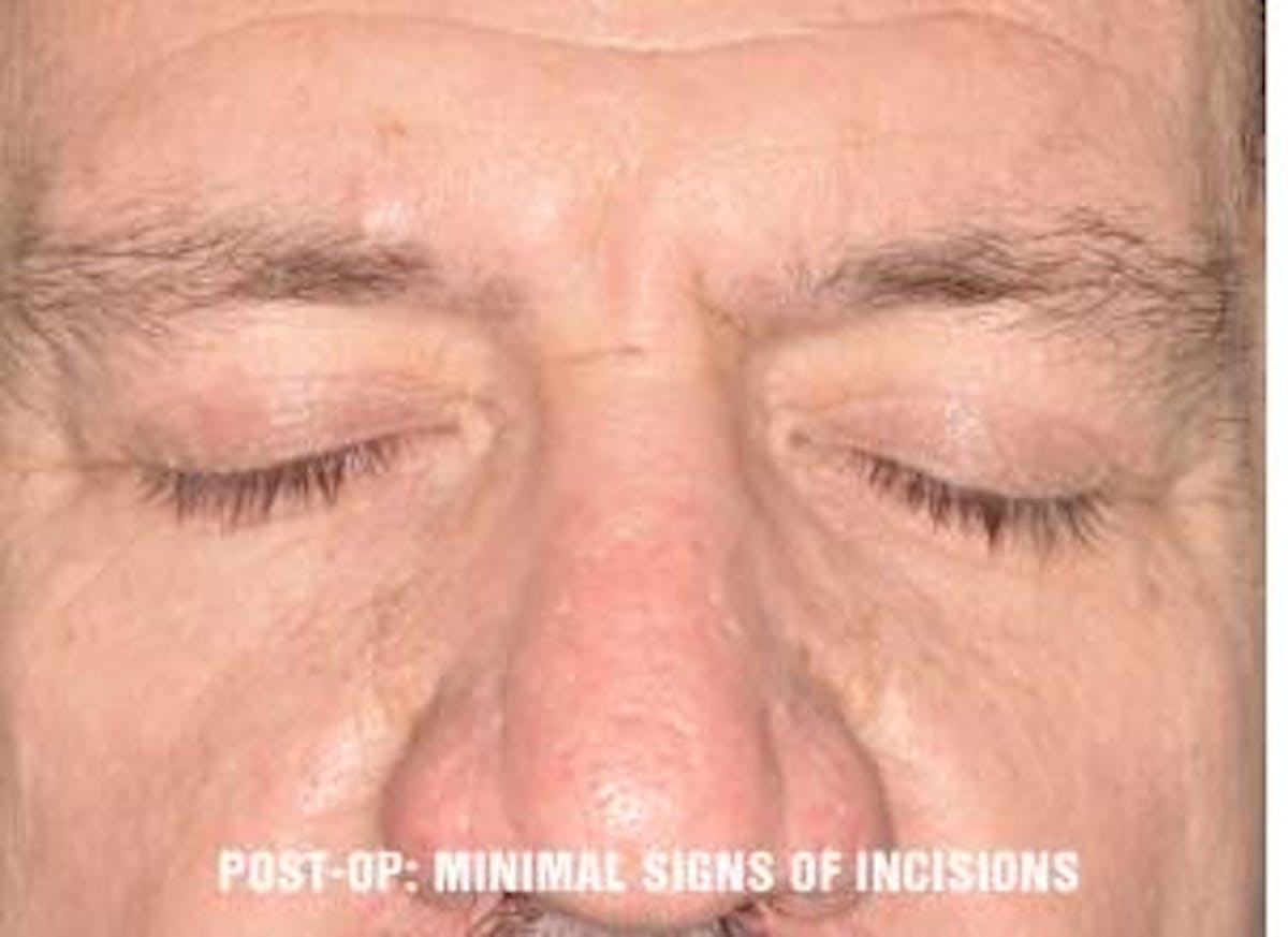 Blepharoplasty before and after, frontal.