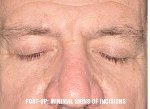 Blepharoplasty before and after, frontal.