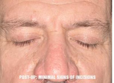 Blepharoplasty before and after, frontal.