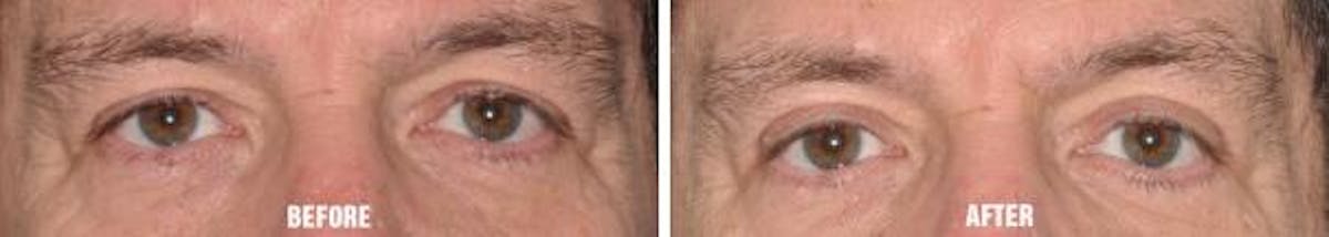 Blepharoplasty before and after, frontal.