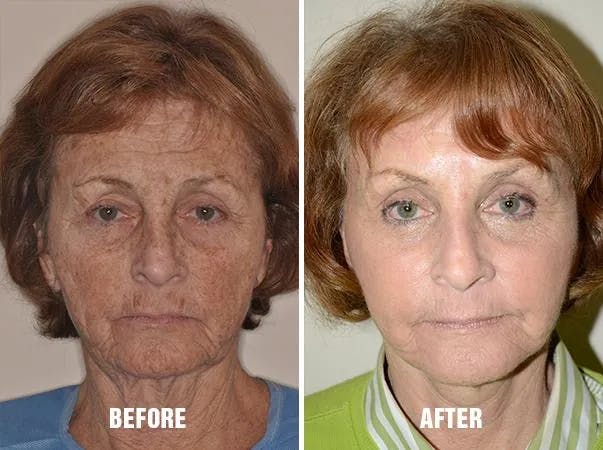 Blepharoplasty before and after, frontal.