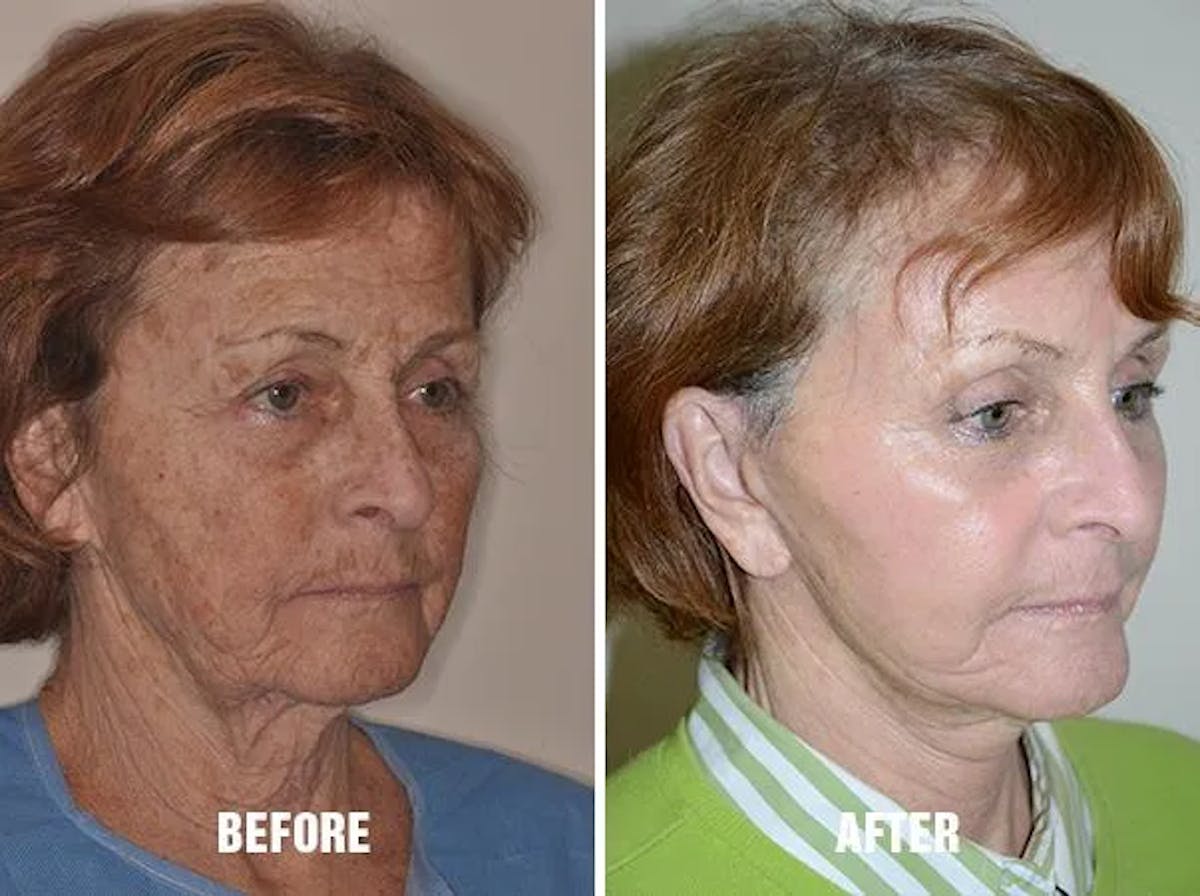 Blepharoplasty before and after, oblique right.