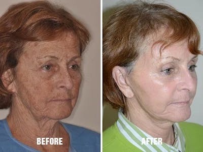 Blepharoplasty before and after, oblique right.
