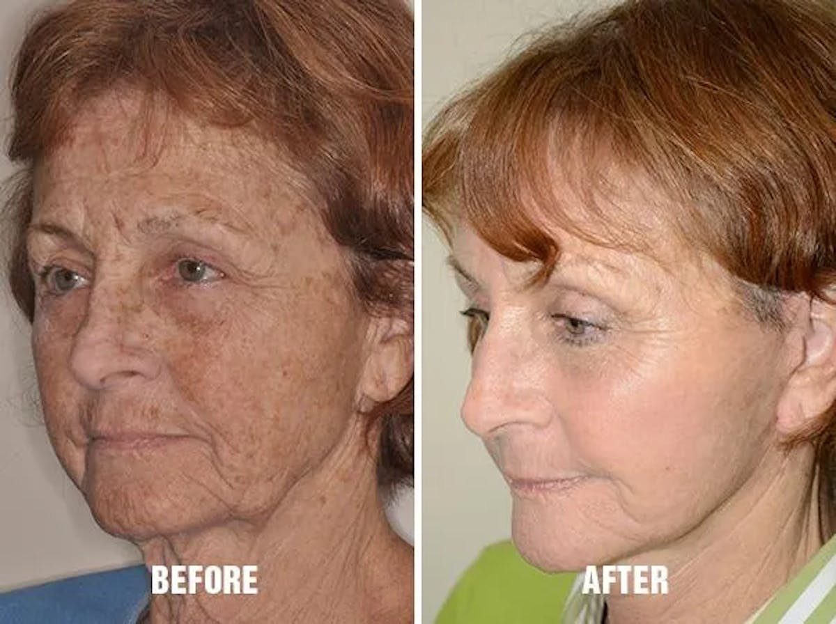 Blepharoplasty before and after, oblique left.