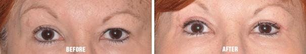 Blepharoplasty before and after, frontal.