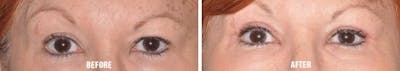 Blepharoplasty before and after, frontal.