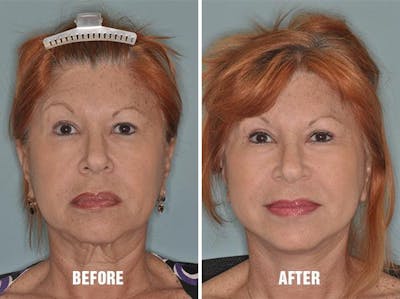 Blepharoplasty before and after, frontal.
