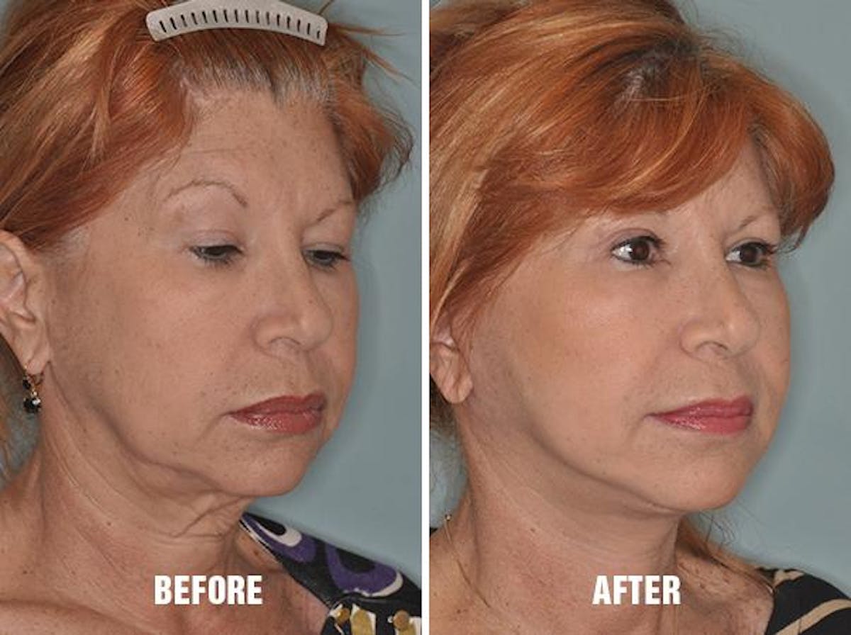 Blepharoplasty before and after, oblique right.