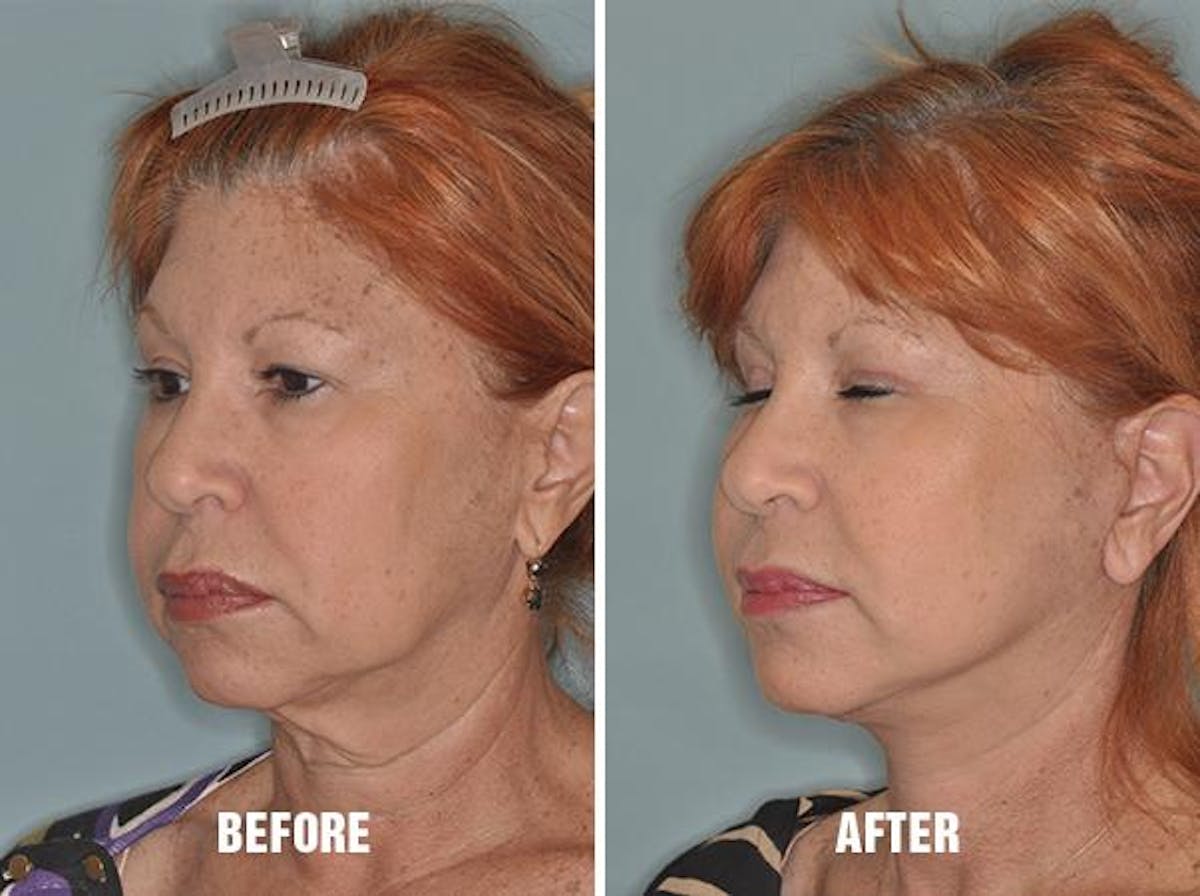 Blepharoplasty before and after, oblique left.