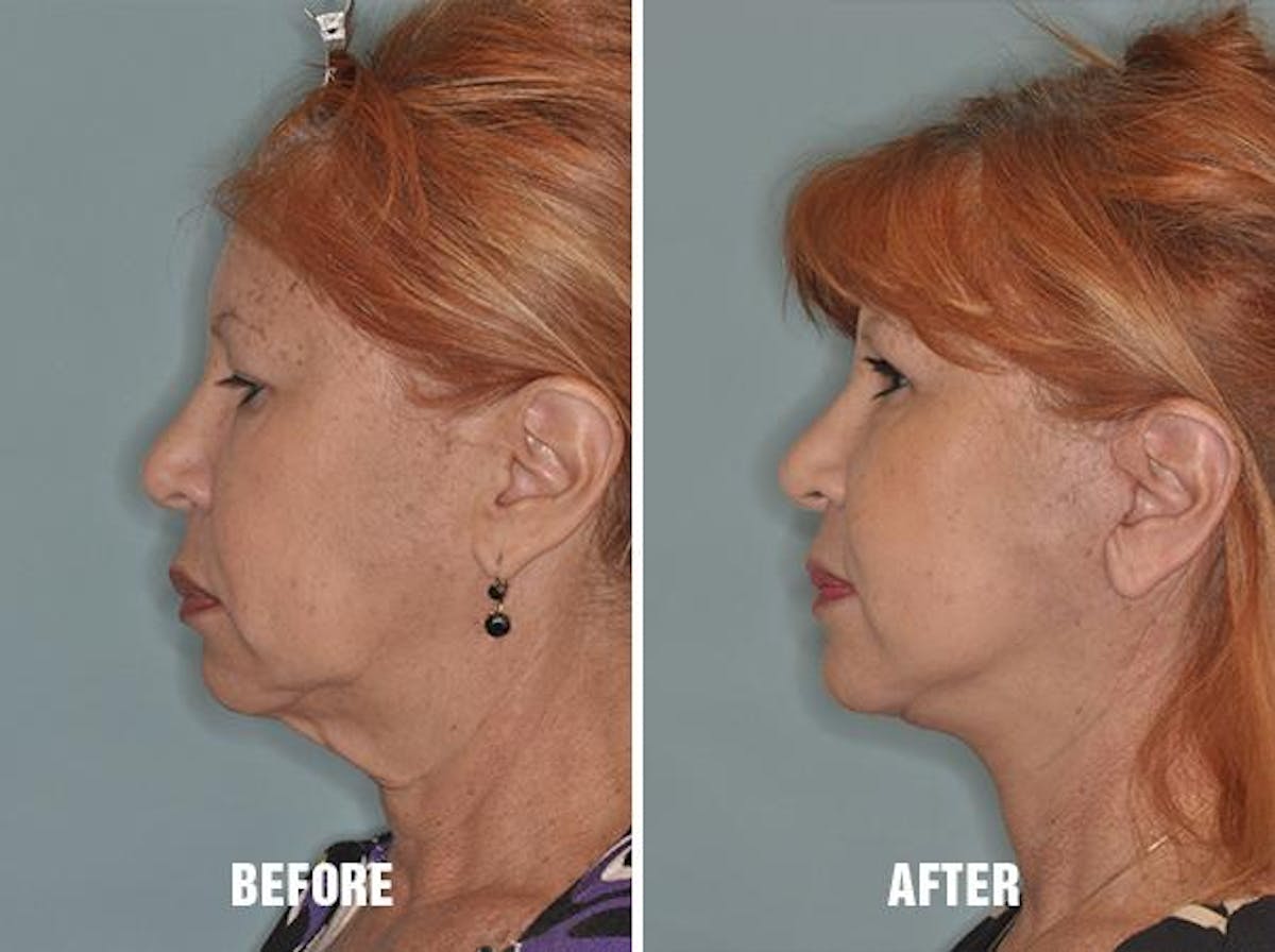 Blepharoplasty before and after, lateral left.